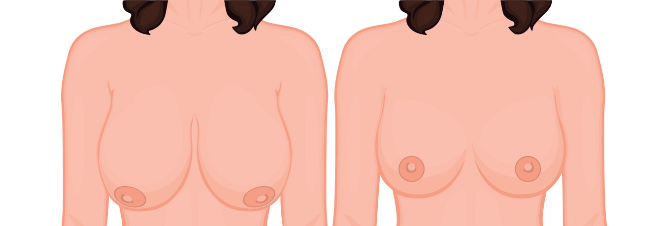 breast reduction surgery